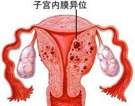 女性为什么会患子宫内膜异位症